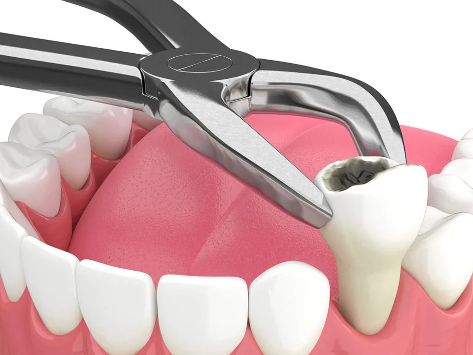 Tooth extractions in Franklin, TN at East Franklin Dentistry.