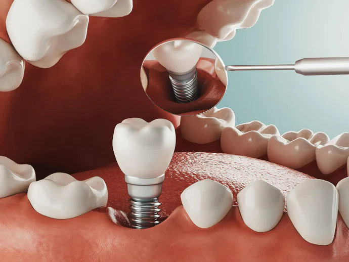 Dental implants in Franklin, TN at East Franklin Dentistry.