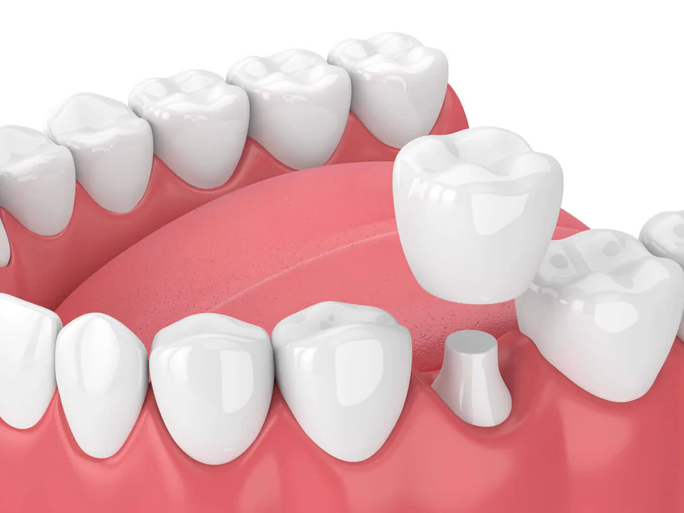 Dental crowns and dental bridges in Franklin, TN at East Franklin Dentistry.
