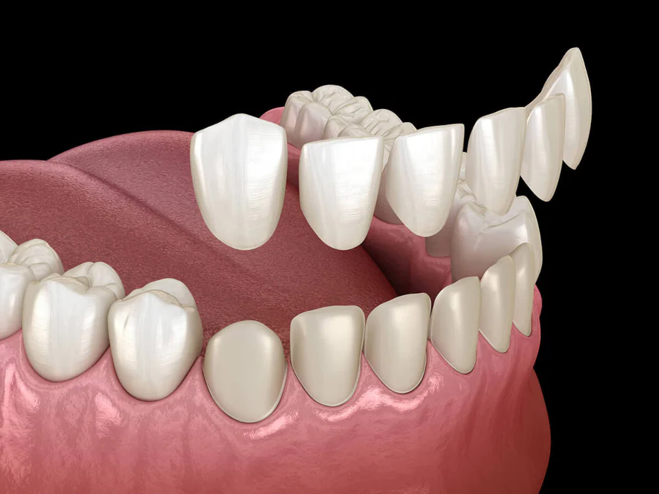 Dental veneers in Franklin, TN at East Franklin Dentistry.