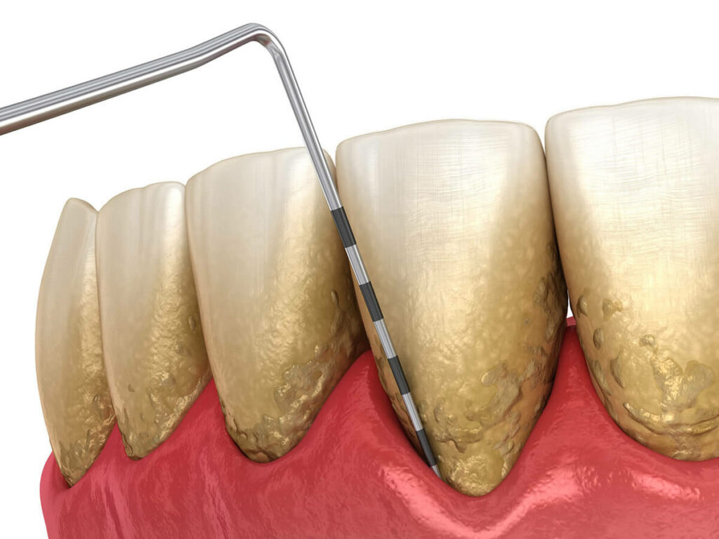 Close-up 3D illustration of teeth with plaque buildup along the gum line, with a dental probe indicating the presence of tartar, highlighting the need for periodontal treatment