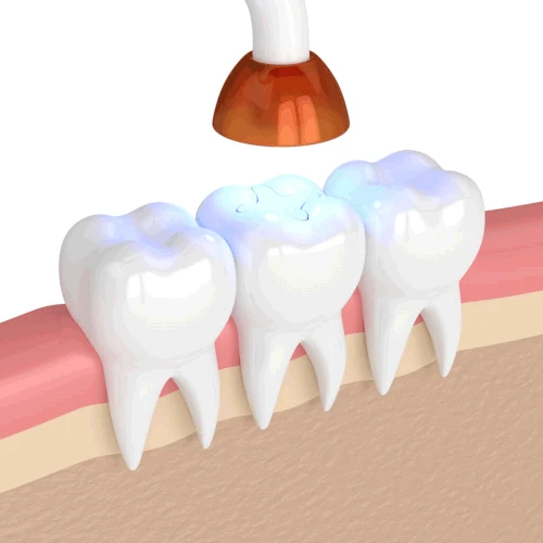 Tooth fillings and dental sealants in Franklin, TN at East Franklin Dentistry.