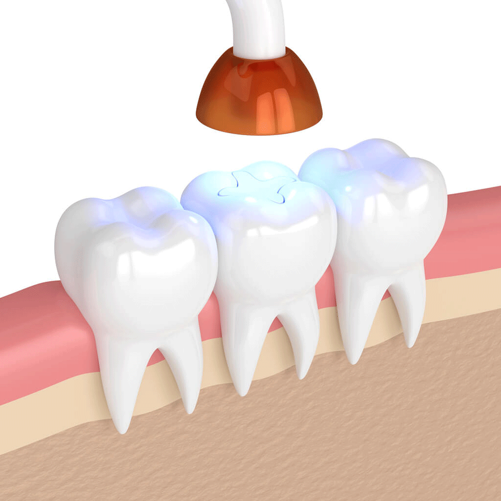 illustration of a light being applied to a tooth filling