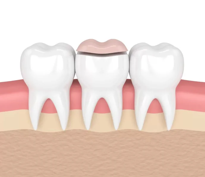 Dental inlays and dental onlays in Franklin, TN at East Franklin Dentistry.