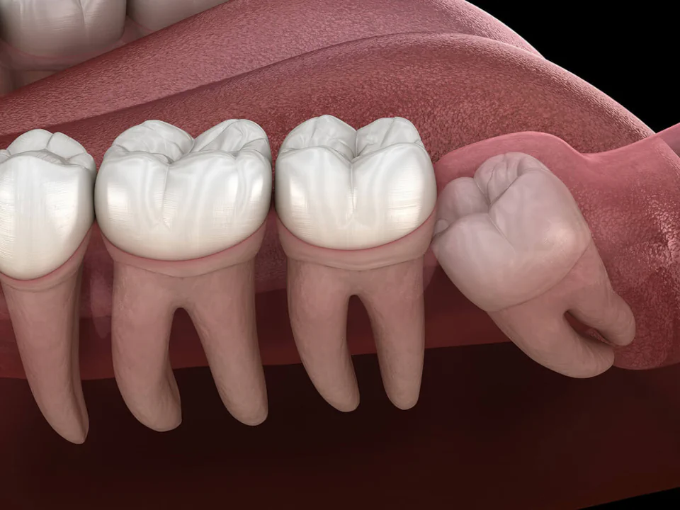 Wisdom tooth removal in Franklin, TN at East Franklin Dentistry.